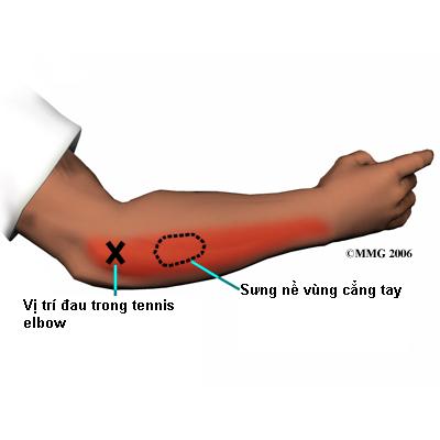 hội chứng Tennis elbow